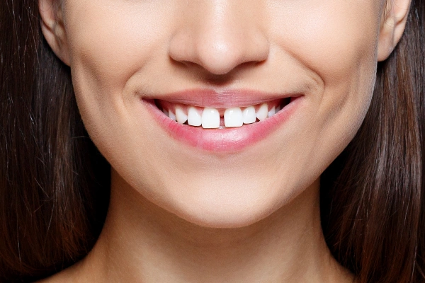 Gaps between teeth